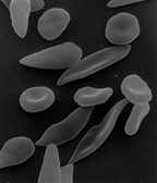 Файл:Sicklecells.jpg