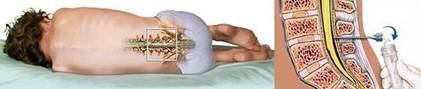 lumbar-puncture