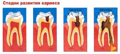 Описание: Стадии кариеса